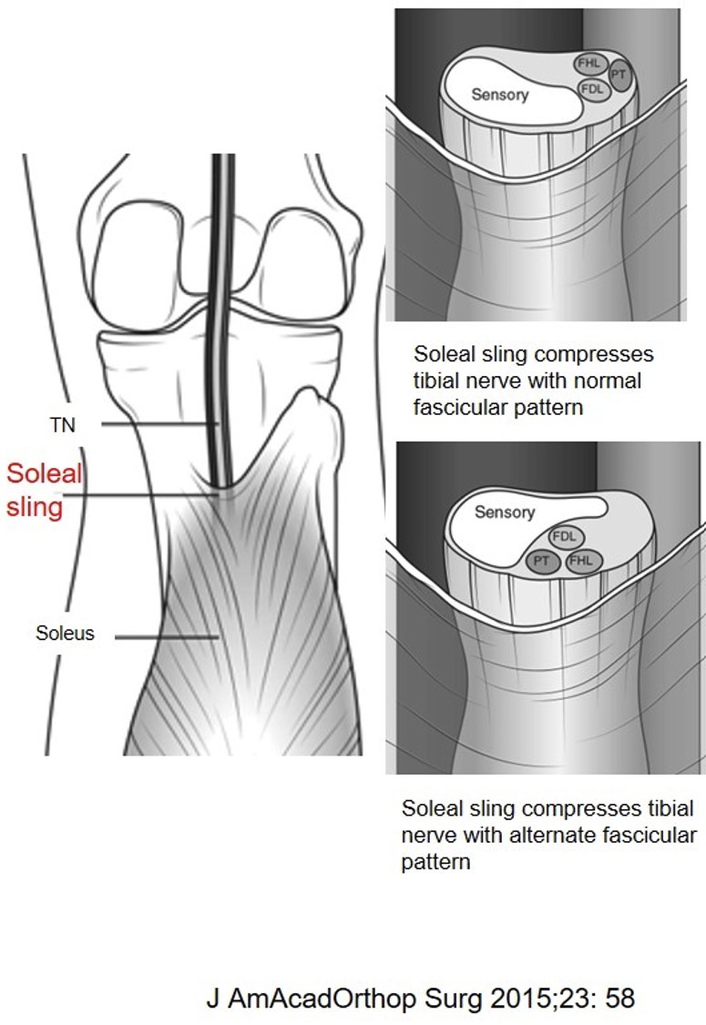 Figure 3 for case Soleus sling